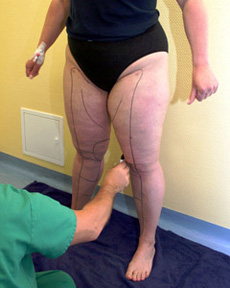 Liposuktion - Anzeichnen am Bein